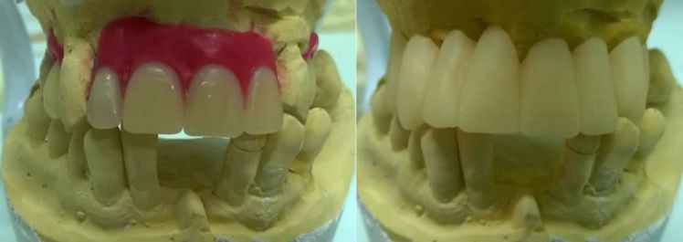 Ceratura diagnostica e preparazione del provvisorio in resina