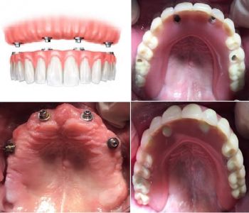 Protesi definitiva dopo circa 6 mesi