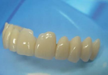 Protesi provvisoria ridotta con denti in resina