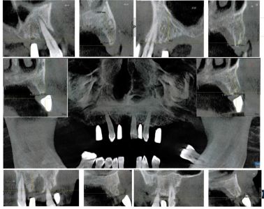 TC Cone Beam 3D con evidenza dei punti di repere e sezioni delle fette ossee da impiantare