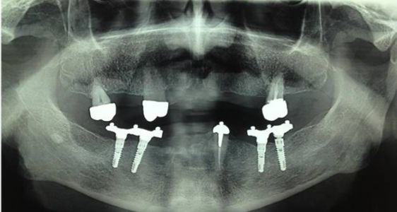 overdenture inferiore con impianti su protesi combinata