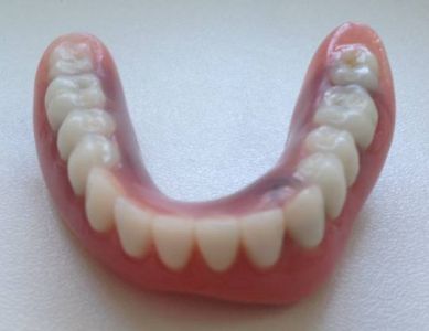 overdenture inferiore con impianti su protesi combinata