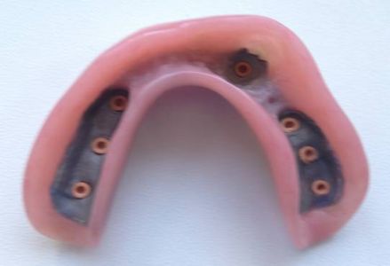 overdenture inferiore con impianti su protesi combinata