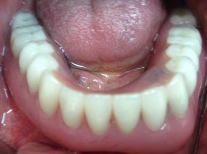 overdenture inferiore con impianti su protesi combinata