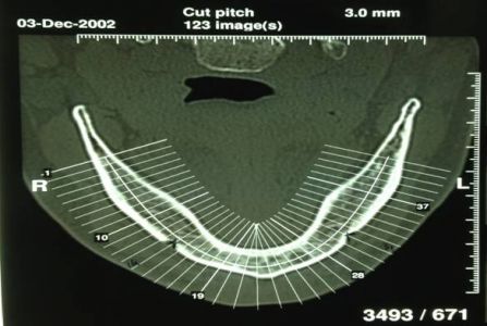 overdenture inferiore con impianti su protesi combinata