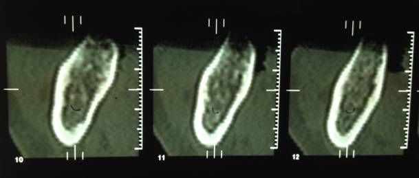 overdenture inferiore con impianti su protesi combinata