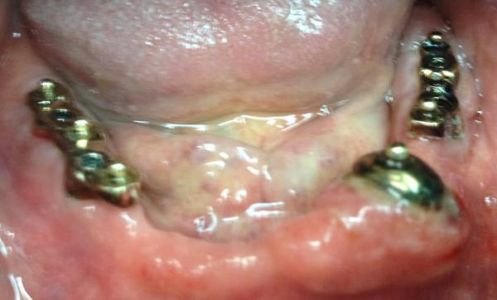 overdenture inferiore con impianti su protesi combinata