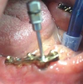 overdenture inferiore con impianti su protesi combinata