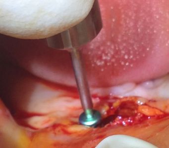 Overdenture su impianti con attacchi sferici in arcata inferiore