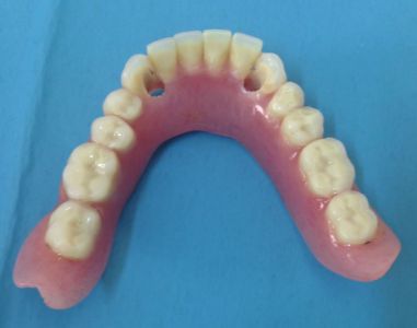 Overdenture su impianti con attacchi sferici in arcata inferiore