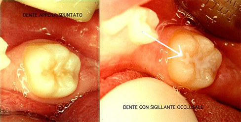 sigillanti