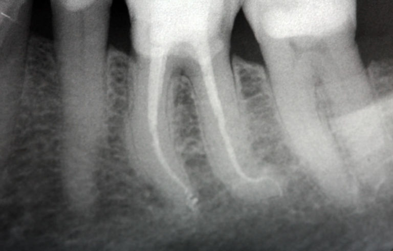 MobilitÃ  dentale ai premolari e molare inferiori.