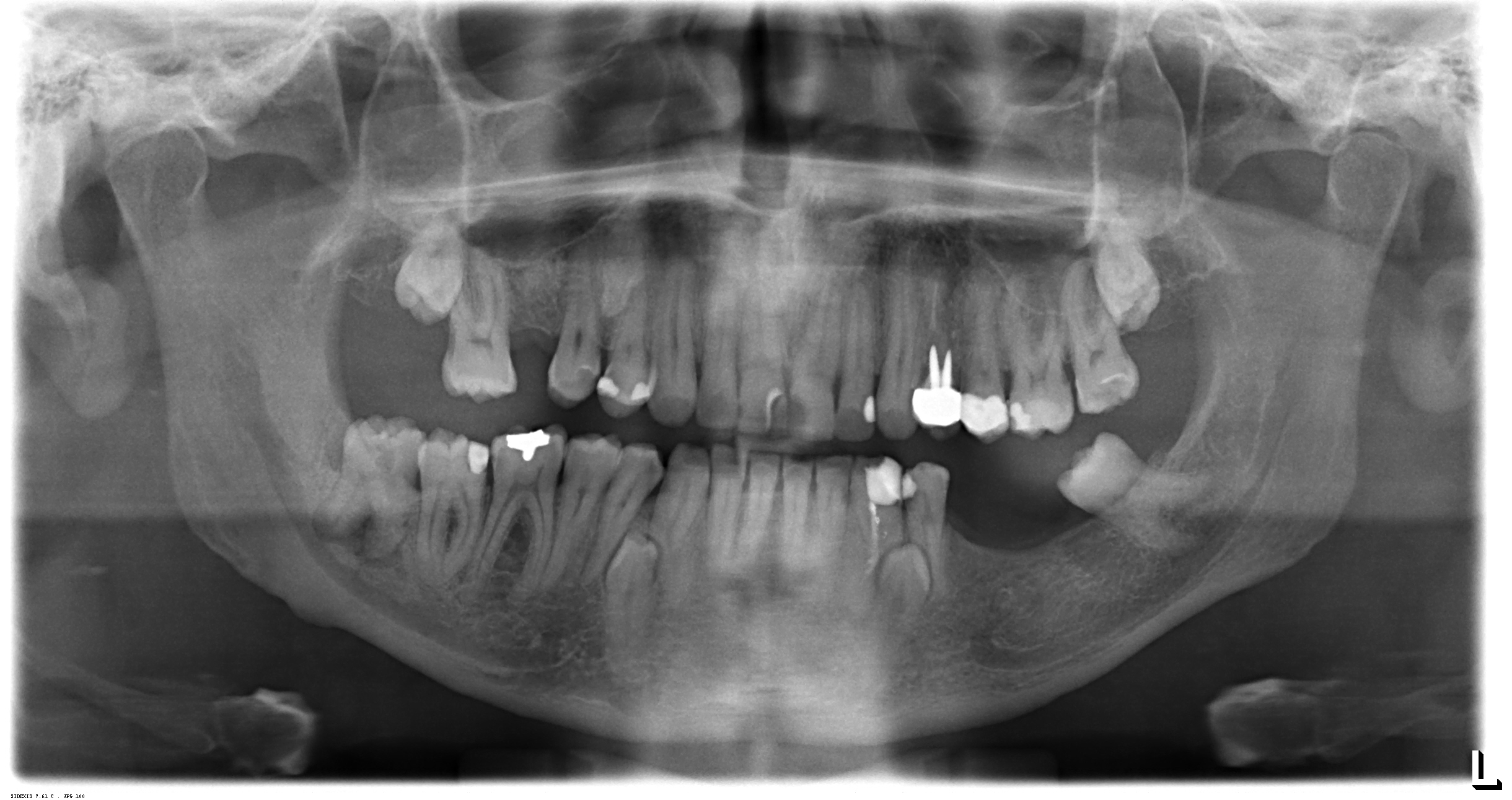 Vorrei mettere due impianti dentali