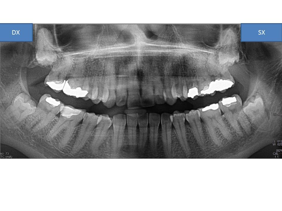 Circa un mese fa ho iniziato ad avvertire un dolore che partiva tipo morsa diffuso all'arcata superiore ed inferiore