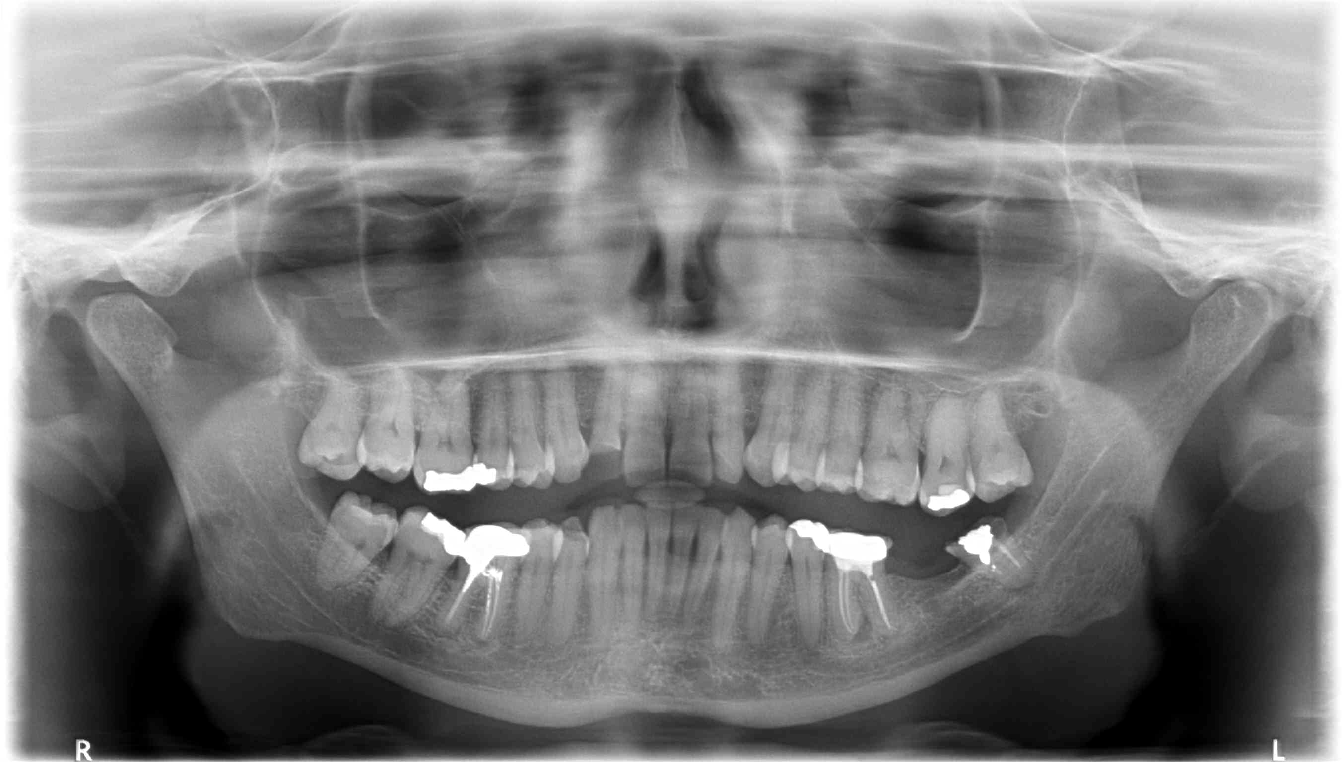 Circa 20 anni fa ho avuto estrazione del 37 per granuloma