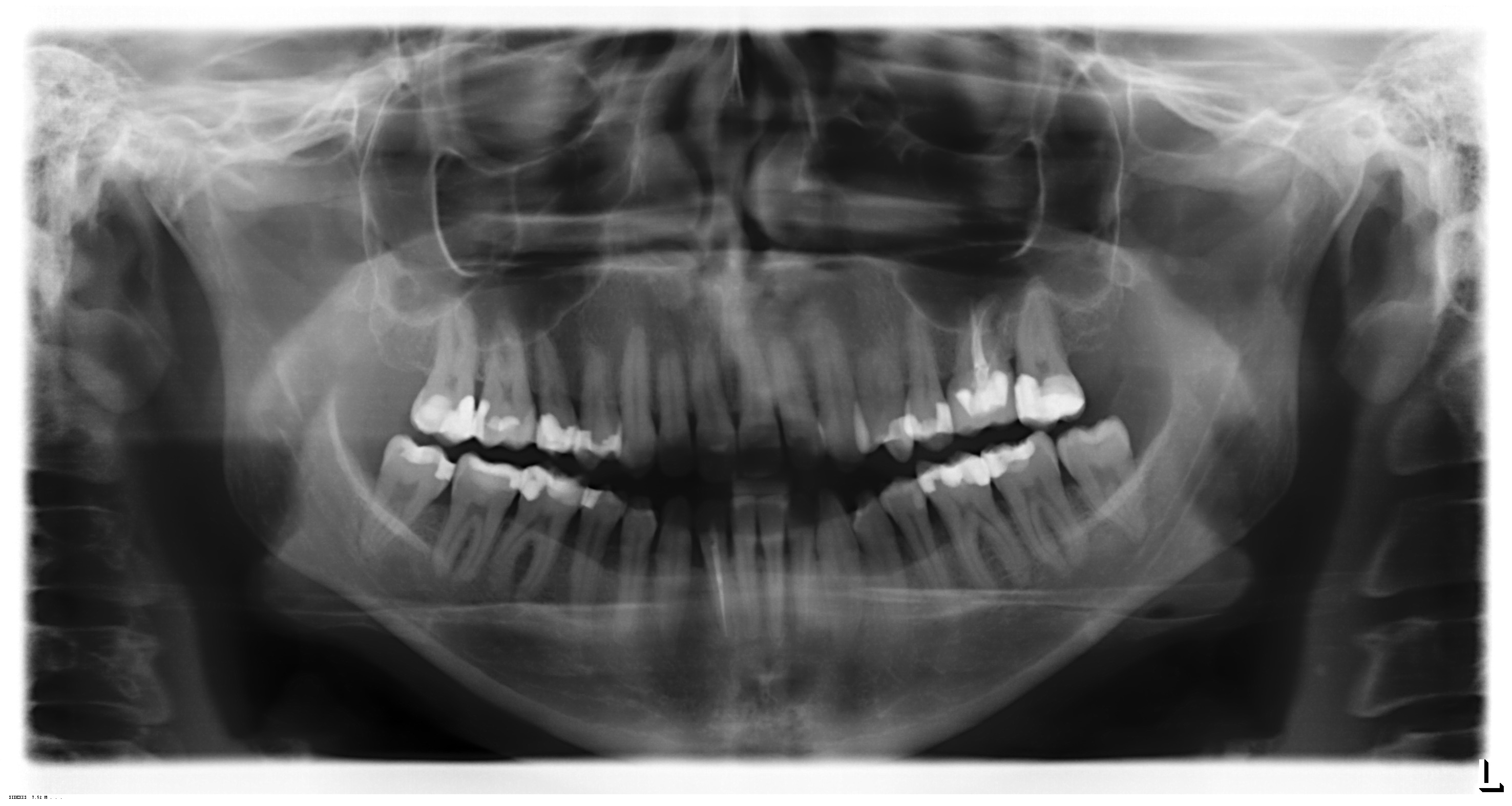 Un mese fa ho subito l'estrazione del dente del giudizio inferiore