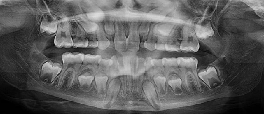 Ã giusto estrarre 2 premolari permanenti a un bambino di neanche 10 anni?