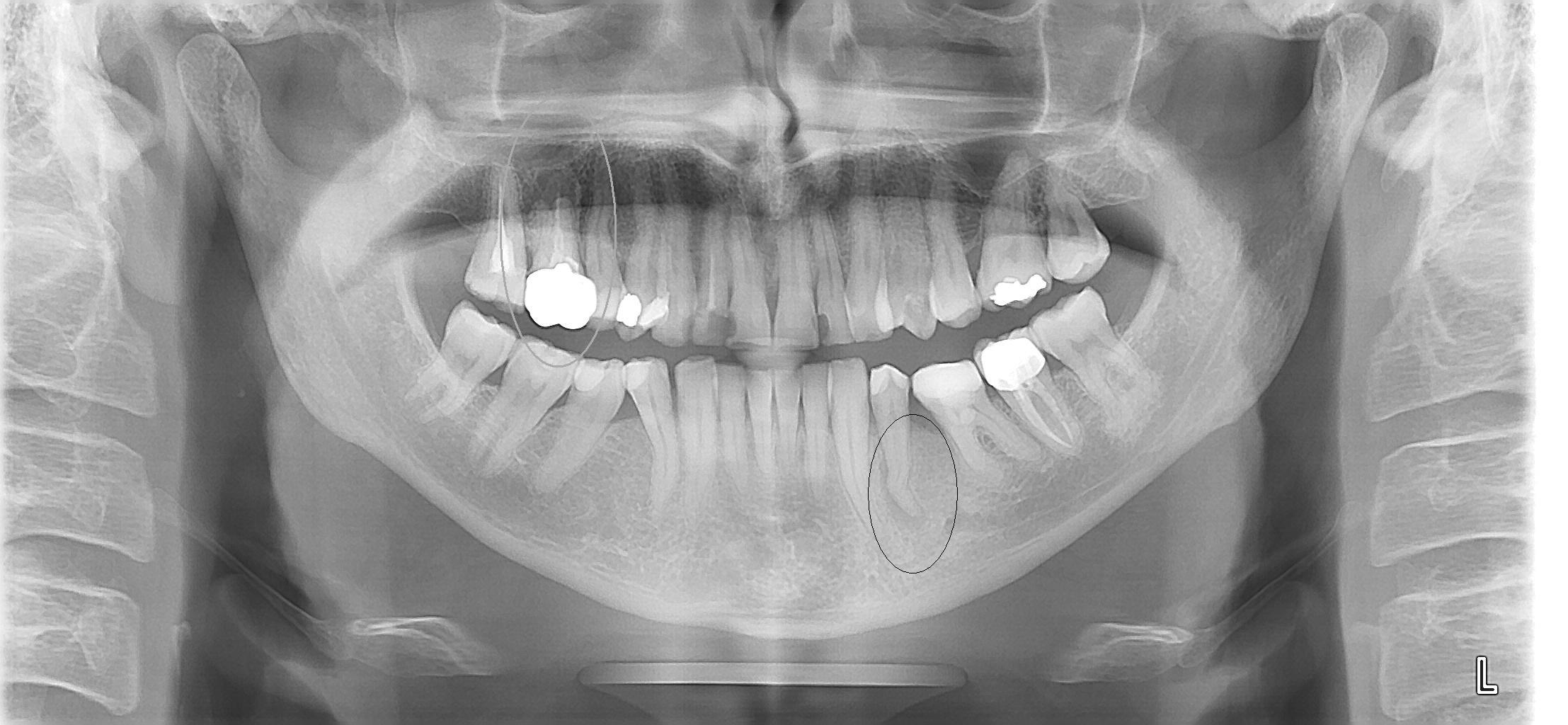 Mi hanno cosigliato la devitalizzazione con apicectomia del dente per un granuloma.