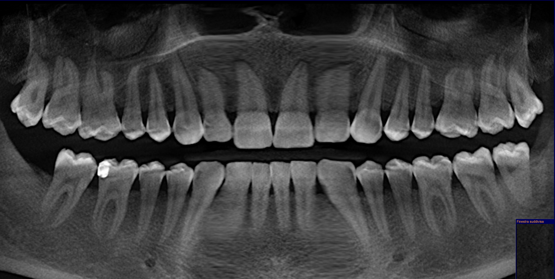 Circa 2 anni fa mi Ã¨ stata diagnosticata una parodontite