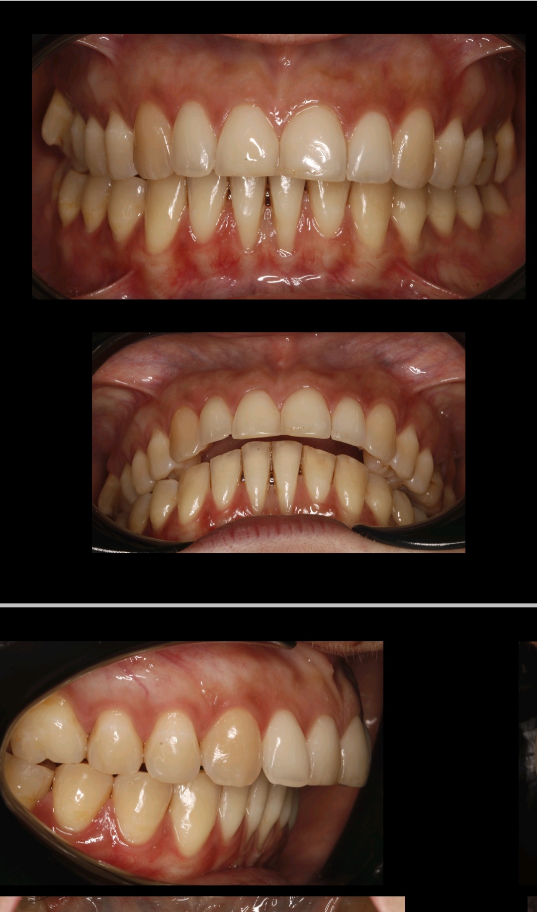 Malocclusione di secondo grado